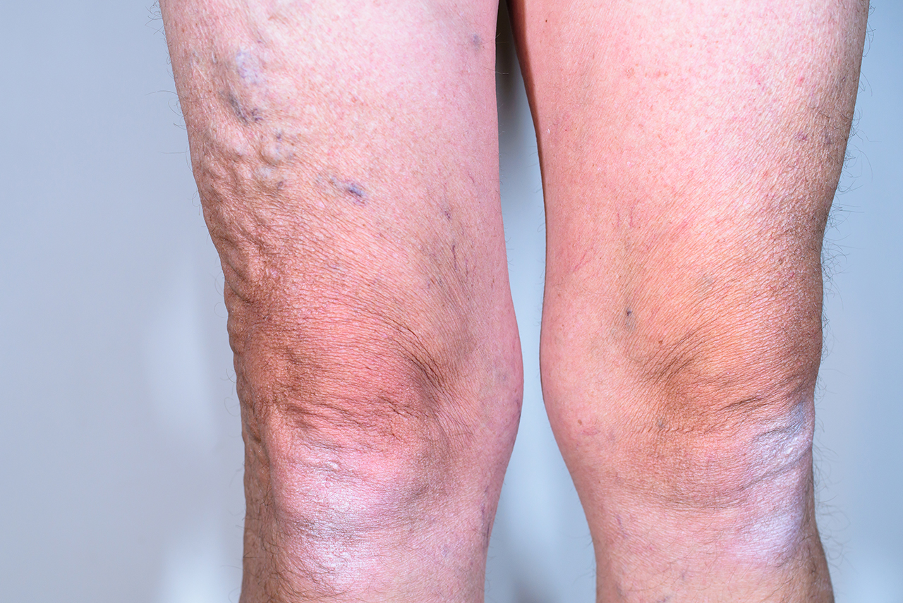 Care After Vein Ablation Beauty And Health Facts Online